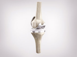 Zimmer Persona Knee Replacement