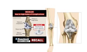 Harford, PC Retained by Client Suffering  Catastrophic Injuries from Exactech Knee Implant